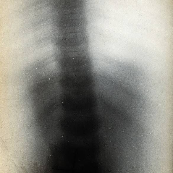 É possível se aposentar com problemas na coluna vertebral?