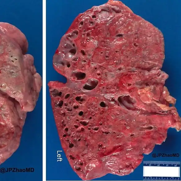 É possível se aposentar com a fibrose cística? Descubra!