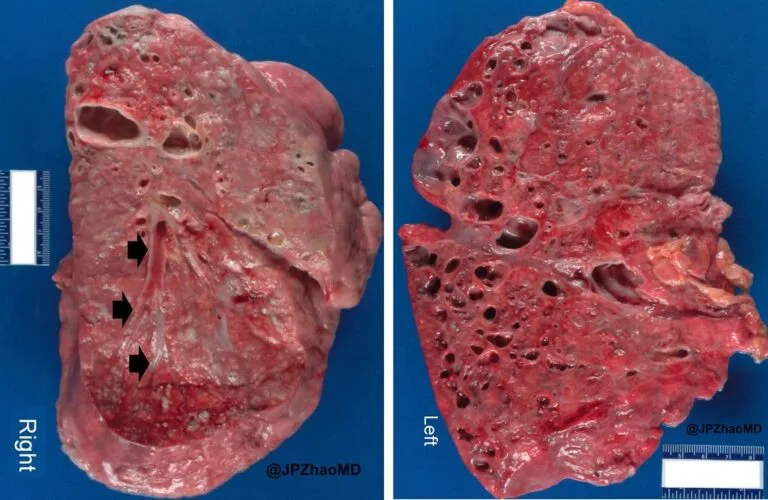 É possível se aposentar com a fibrose cística? Descubra!