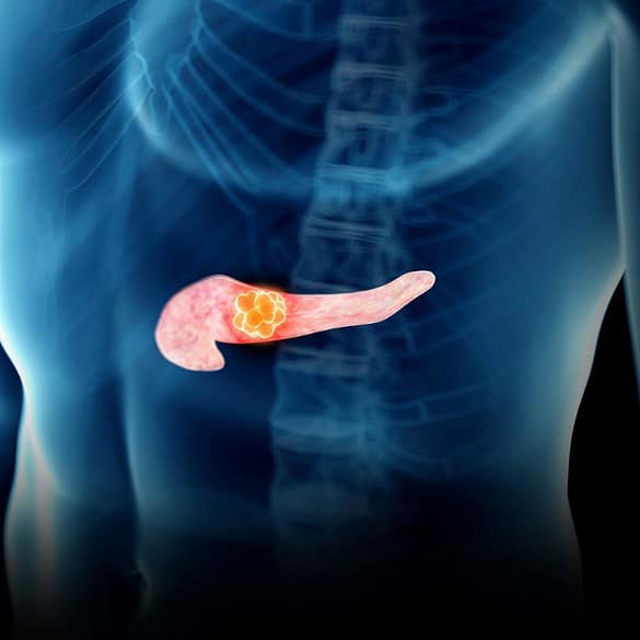 Radiografia do tronco humano mostrando câncer de pâncreas em destaque. Ilustração médica do sistema digestivo.