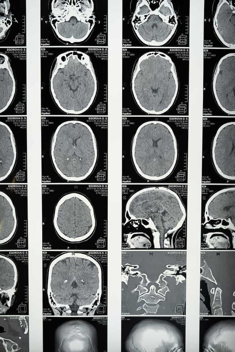 Medical imaging of the brain