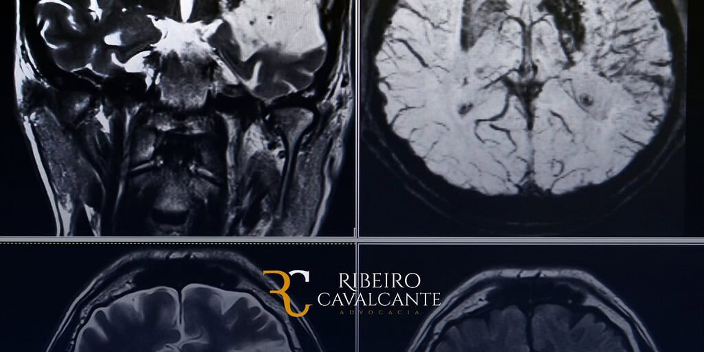 Exemplos de incapacidades causadas pelo avc: