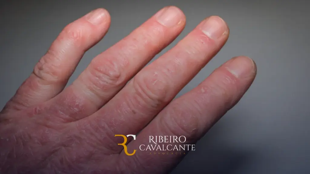 Mão com sinais de eczema em close-up